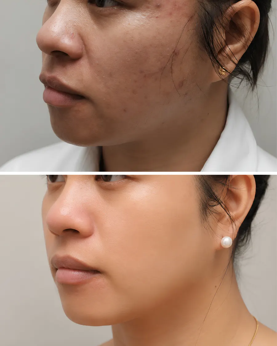 Advanced Laser Skin Brightening at Cinch Clinics